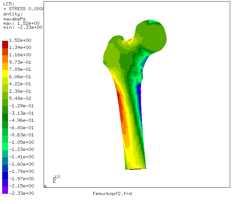 Highest principal stress - front view